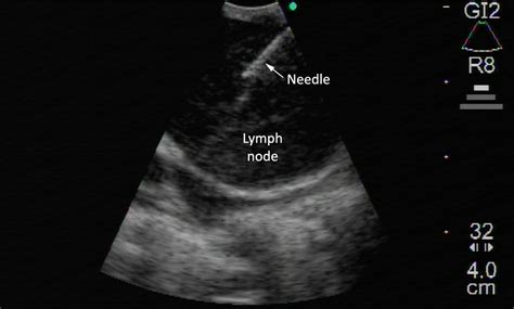 Endobronchial Ultrasound Ebus From A Leading European Expert The Lung