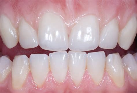 Prettau Dispersive De Zirkonzahn Zirconia Altamente Transl Cida Y