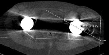 Posterior Femoral Neck Impingement Secondary To Excess Acetabular