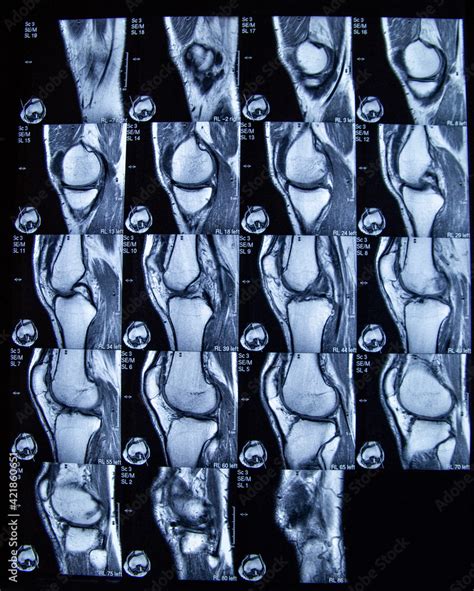 Magnetresonanztomographie MRT Von Einem Knie Kniegelenk Stock