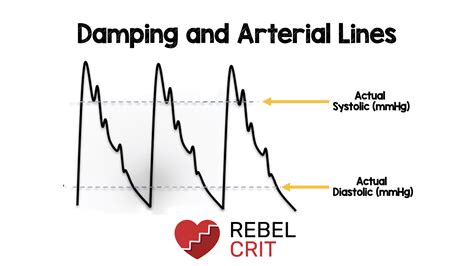 Damping and Arterial Lines - REBEL EM - Emergency Medicine Blog