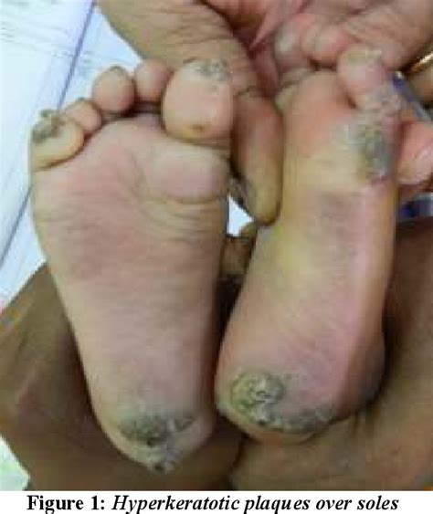 Figure From Richner Hanhart Syndrome A Case Report Of An Month