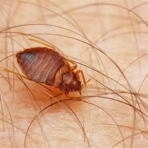 A Bed Bug On The Skin Of Someone S Stomach