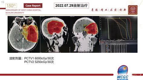 【会议报道】四川大学华西医院胶质瘤多学科诊疗（mdt）院际交流 脑医汇 神外资讯 神介资讯
