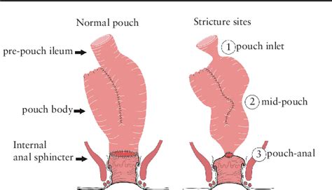 Internal J Pouch