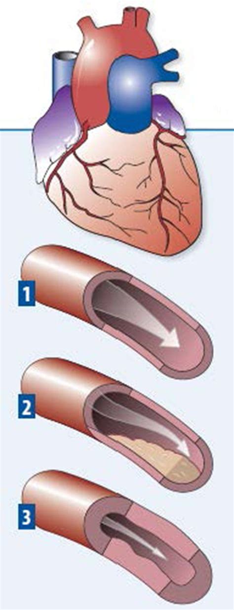 Research Shows Non Obstructive Cad Poses Serious Heart Attack Risks Heart Advisor