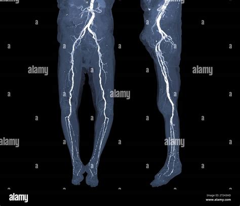 Cta Femoral Artery Run Off Image Of Femoral Artery For Diagnosis Acute