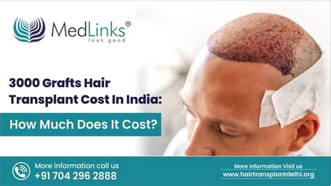 3000 Grafts Hair Transplant Cost In India | Medlinks