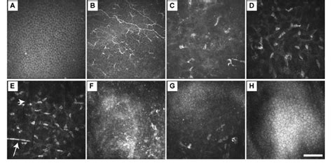 Representative In Vivo Confocal Microscopy Ivcm Images Obtained