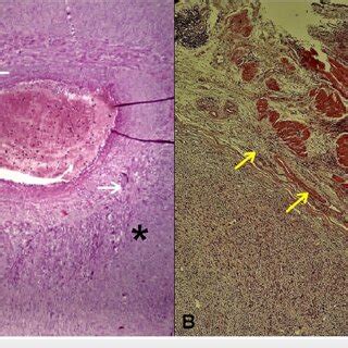 Photomicrograph Image Showing Histopathological Features Of