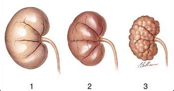 Leczenie Pkd Objawy Torbieli Nerkowych