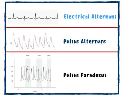 Pulsus Alternans Causes Signs Symptoms NurseShip