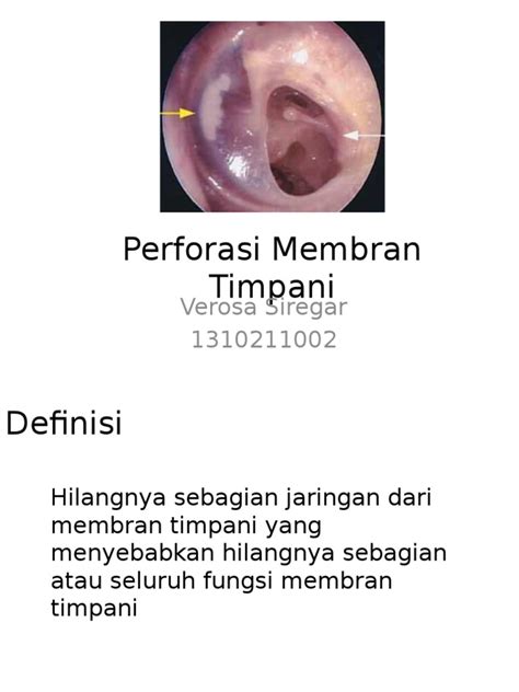 Perforasi Membran Timpani Pdf