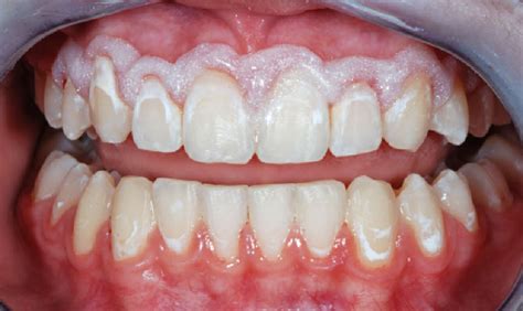 Efficacy Of 4 Year Treatment Of Icon Infiltration Resin On