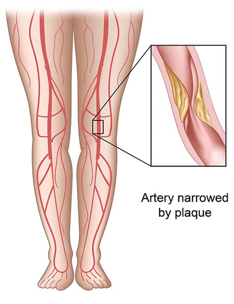 Peripheral Artery Disease Pad Conditions And Treatments La