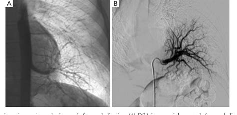 Figure 1 From Transcatheter Embolization Of A Large Aberrant Systemic