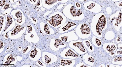 病理干货 乳腺浸润性微乳头状癌病例分享 MedSci cn