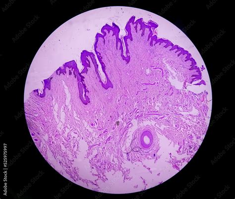 Histological Biopsy Of Scrotal Wall Under Microscopy Showing Calcinosis