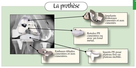Prothèse Totale De Genou Dr Yves Rouxel