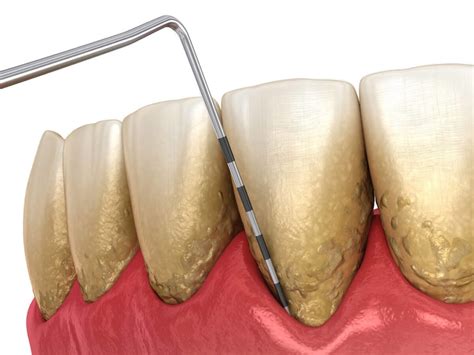 Gum Disease - Periodontal Disease Treatment - The Dentist of Siouxland