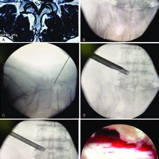 (PDF) Outcome of lumbar lateral recess stenosis with percutaneous ...