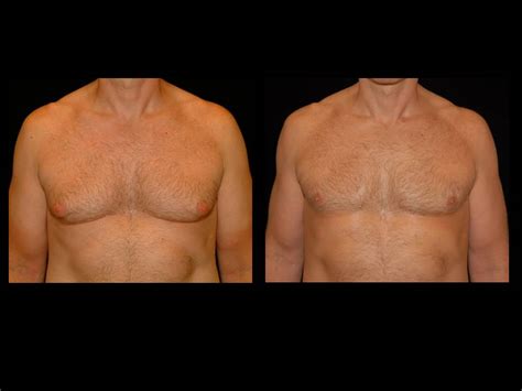 Gynecomastia Before And After Premier Plastic Surgery