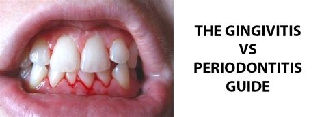 The Gingivitis Vs Periodontitis Guide See The Differences