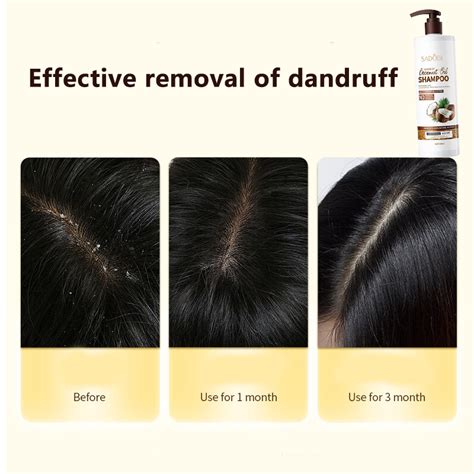 Hb Original Anti Dandruff Shampoo Coconut Oil Shampoo Kelemumur Ubat