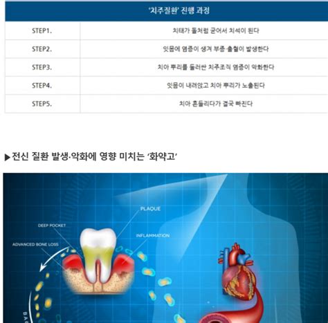 치아 빠지고 당뇨병 심해진다는 신호 무시했군요 전신 건강 문제 단초 ‘치주질환 심각성