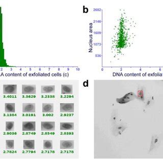 Dna Ploidy Analysis In The Patient With Moderate To Severe Dysplastic