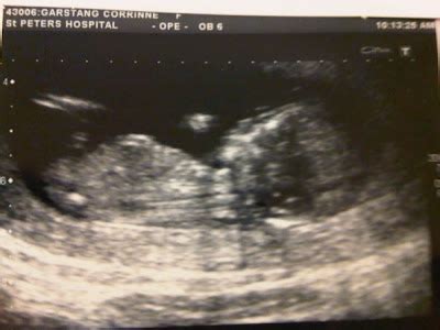 A Record of My Pregnancy: Scan 12 weeks, 4 days