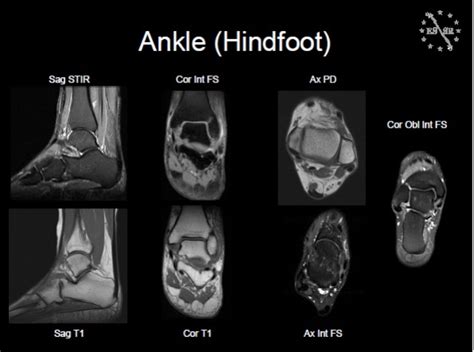 Anklefoot Mri