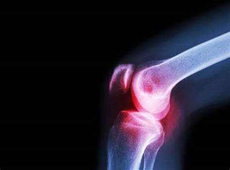 septic arthritis   symptoms  treatment step  health