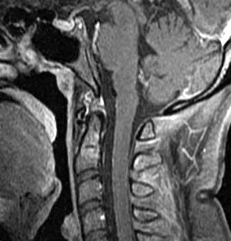 Lateral Ct At The Level Of C1 Showing Inferior Accessory Ossicle Of The Download Scientific