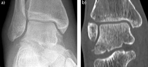 Talar Process Fractures An Overview And Update Of The Literature In Efort Open Reviews Volume