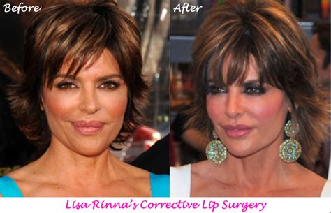 Surgery Lisa Rinna Lips