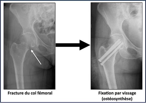 Fracture Du Col Du Fémur Dr Simon Tournemine