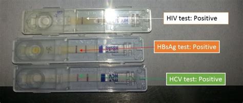 Hiv Hbsag And Hcv Tests Introduction Principle Procedure And Result