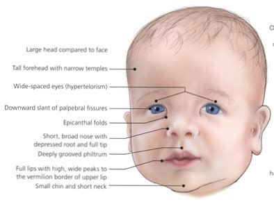 facial_features | Noonan Syndrome Awareness Association