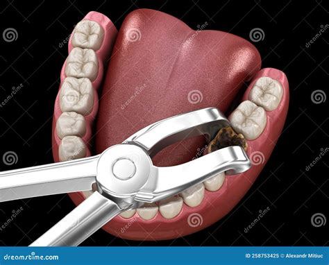 Extraction of Molar Tooth Damaged by Caries. Medically Accurate Tooth ...