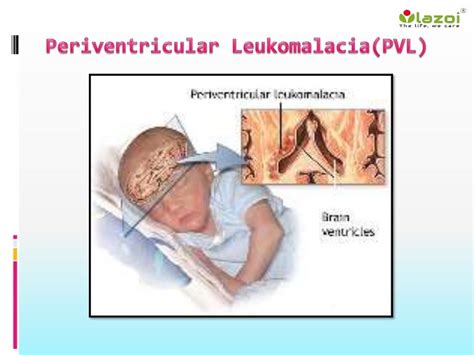 Periventricular Leukomalacia Pvl