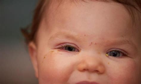 6 Things to Know About Conjunctivitis in Children (pink eye) – Things ...