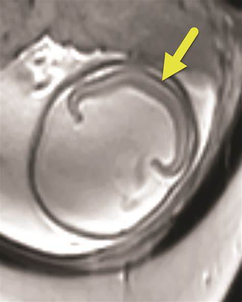 Alobar Holoprosencephaly Applied Radiology