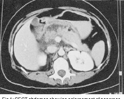 Figure From Acute Renal Failure In Acute Pancreatitis Role Of