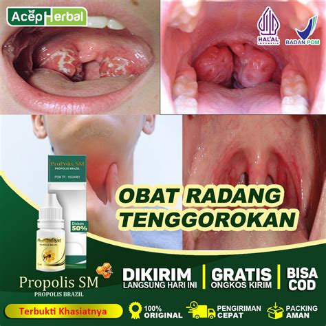 Jual Obat Tenggorokan Terlengkap Harga Terbaru Februari Shopee