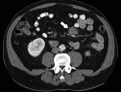 Incidental Findings At Initial Imaging Workup Of Patients With Prostate