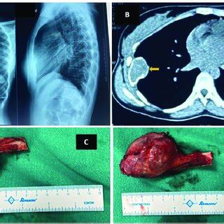 Chest X Ray Posterior Anterior View Showing Nodular Sclerotic Lesion