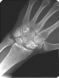 Scapholunate Dissociation Radiology Key