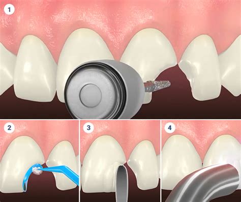 Cosmetic Dental Bonding Professional Website Blog Article By South