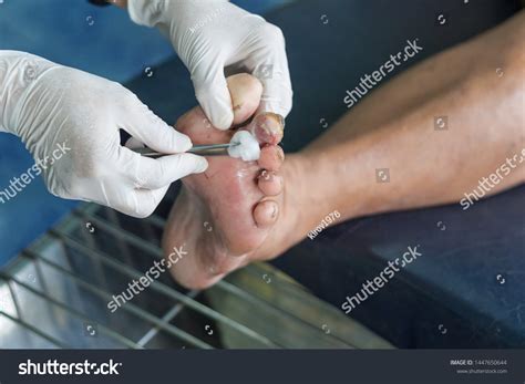 Infected Wound Diabetic Foot库存照片1447650644 Shutterstock